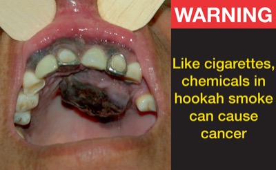 mouth cancer from smoking